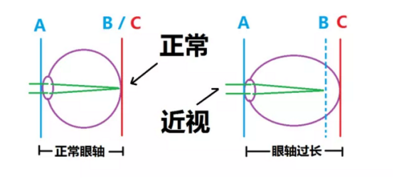 蝶适DISC：近视可以通过锻炼自愈吗？ 答案意想不到！